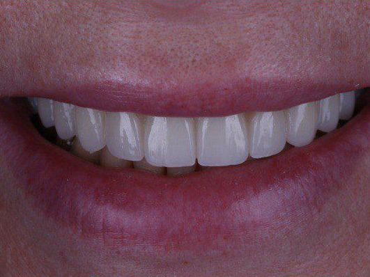 Dental Zirconia Block factory - Zirconia Disc manufacturer from China